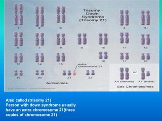 Also called (trisomy 21)
Person with down syndrome usually
have an extra chromosome 21(three
copies of chromosome 21)
 