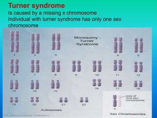 Turner syndrome
Is caused by a missing x chromosome .
Individual with turner syndrome has only one sex
chromosome
 
