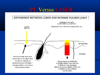 IPLIPL VersusVersus LASERLASER
 