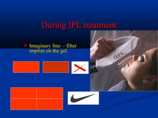 During IPL treatmentDuring IPL treatment
 Imaginary line – filterImaginary line – filter
imprint on the gel.imprint on the gel.
 