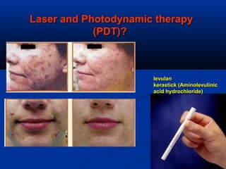 Laser and Photodynamic therapyLaser and Photodynamic therapy
(PDT)?(PDT)?
levulanlevulan
kerastick (Aminolevulinickerastick (Aminolevulinic
acid hydrochloride)acid hydrochloride)
 
