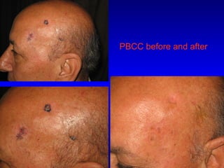 PBCC before and after
 