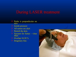 During LASER treatmentDuring LASER treatment
 Probe is perpendicular onProbe is perpendicular on
skinskin
 Gentle pressureGentle pressure
 All senses are alertAll senses are alert
 Stretch the skin.Stretch the skin.
 Vacuum for fumes – virusVacuum for fumes – virus
filter.filter.
 Overlap 10-20 %Overlap 10-20 %
 Imaginary line.Imaginary line.
 