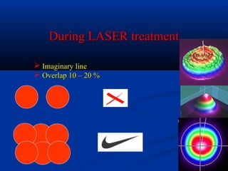 During LASER treatmentDuring LASER treatment
 Imaginary lineImaginary line
 Overlap 10 – 20 %Overlap 10 – 20 %
 