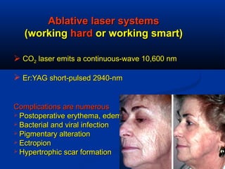Ablative laser systemsAblative laser systems
(working(working hardhard or working smart)or working smart)
 COCO22 laserlaser emits a continuous-wave 10,600 nmemits a continuous-wave 10,600 nm
 Er:YAG short-pulsed 2940-nmEr:YAG short-pulsed 2940-nm
Complications are numerousComplications are numerous
 Postoperative erythema, edemaPostoperative erythema, edema
 Bacterial and viral infectionBacterial and viral infection
 Pigmentary alterationPigmentary alteration
 EctropionEctropion
 Hypertrophic scar formationHypertrophic scar formation
 