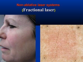 Non-ablative laser systemsNon-ablative laser systems
((Fractional laserFractional laser))
 