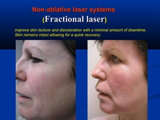 Non-ablative laser systemsNon-ablative laser systems
((Fractional laserFractional laser))
improve skin texture and discoloration with a minimal amount of downtime.
Skin remains intact allowing for a quick recovery.
 