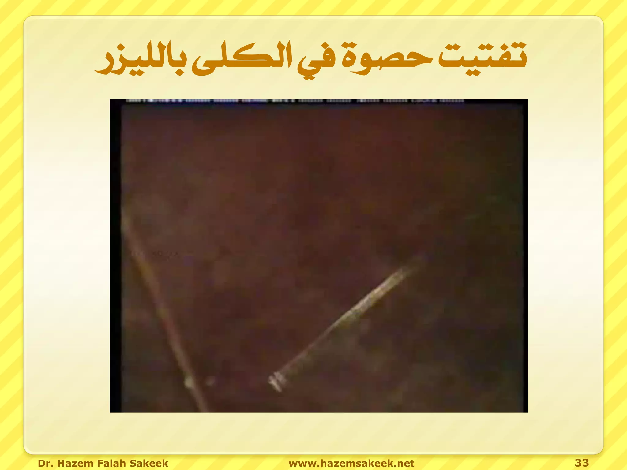 ‫تفتيت حصوة يف الكلى بالليزر‬




Dr. Hazem Falah Sakeek   www.hazemsakeek.net   33
 