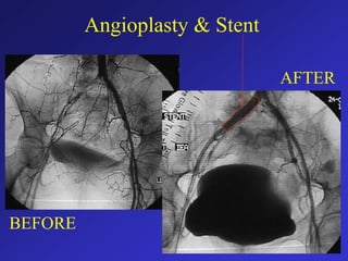 BEFORE
Angioplasty & Stent
AFTER
 