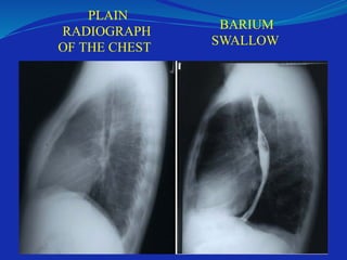 PLAIN
RADIOGRAPH
OF THE CHEST
BARIUM
SWALLOW
 