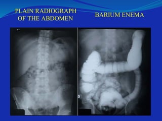 PLAIN RADIOGRAPH
OF THE ABDOMEN
BARIUM ENEMA
 