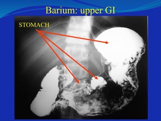 Barium: upper GI
STOMACH
 