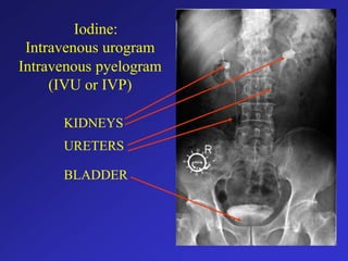Iodine:
Intravenous urogram
Intravenous pyelogram
(IVU or IVP)
KIDNEYS
URETERS
BLADDER
 
