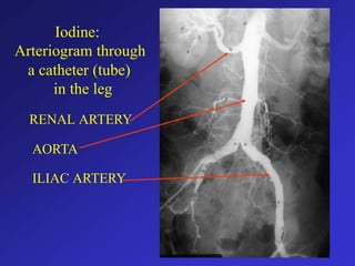 Iodine:
Arteriogram through
a catheter (tube)
in the leg
RENAL ARTERY
AORTA
ILIAC ARTERY
 