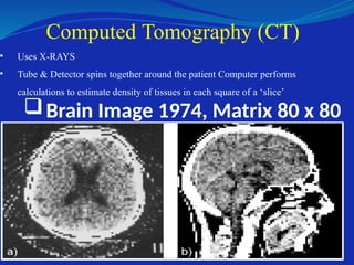 • Uses X-RAYS
• Tube & Detector spins together around the patient Computer performs
calculations to estimate density of tissues in each square of a ‘slice’
Computed Tomography (CT)
Brain Image 1974, Matrix 80 x 80
 
