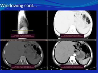 Windowing cont…
 