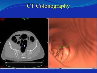 CT Colonography
 