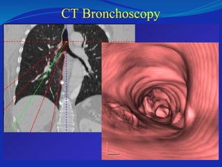 CT Bronchoscopy
 