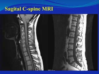 Sagital C-spine MRI
 