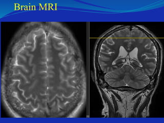 Brain MRI
 