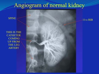 Angiogram of normal kidney
SPINE
THIS IS THE
CATHETER
COMING
UP FROM
THE LEG
ARTERY
11TH RIB
 