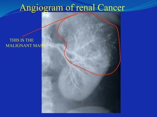 Angiogram of renal Cancer
THIS IS THE
MALIGNANT MASS
 
