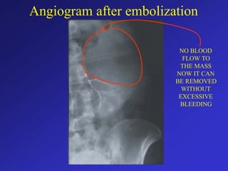 Angiogram after embolization
NO BLOOD
FLOW TO
THE MASS
NOW IT CAN
BE REMOVED
WITHOUT
EXCESSIVE
BLEEDING
 