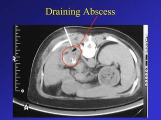 Draining Abscess
 