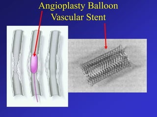 Angioplasty Balloon
Vascular Stent
 