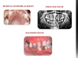 INTRODUCTION TO MOUTH PREPARATION FOR RPD AND FPD.pptx
