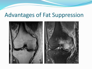 Advantages of Fat Suppression
 