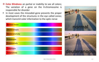 MC-PhD/2017/03 13
 Color Blindness an partial or inability to see all colors;
The variation of a gene on the X-chromosome is
responsible for disorder
 In most cases the miscoded gene prevents the proper
development of the structures in the eye called cones;
which transmit color information to the optic nerve
 