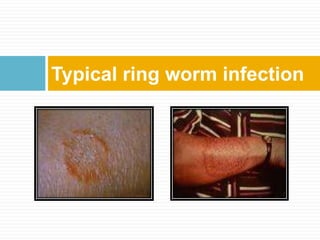 Typical ring worm infection
 