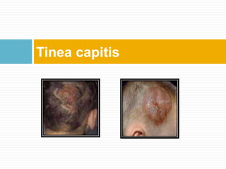 Tinea capitis
 