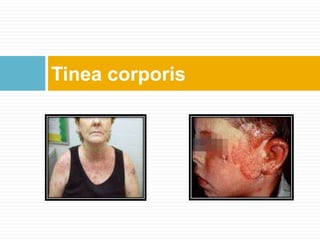 Tinea corporis
 