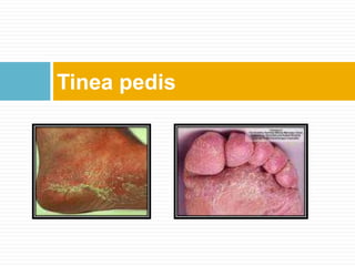 Tinea pedis
 