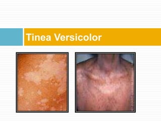 Tinea Versicolor
 