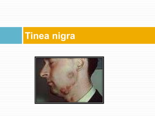 Tinea nigra
 
