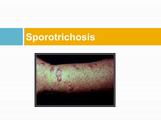Sporotrichosis
 