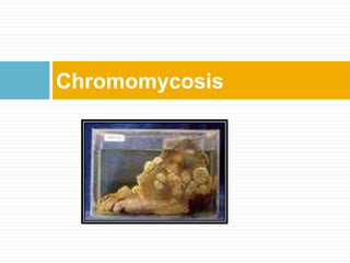 Chromomycosis
 