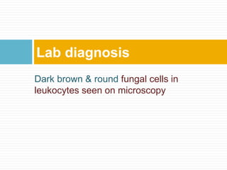 Dark brown & round fungal cells in
leukocytes seen on microscopy
Lab diagnosis
 