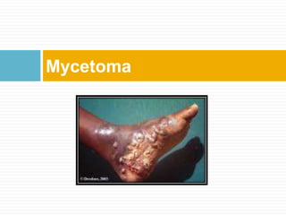 Mycetoma
 