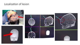 Localization of lesion
 
