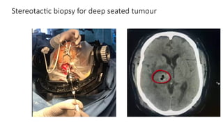Stereotactic biopsy for deep seated tumour
 