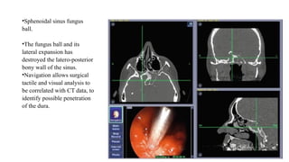 •Sphenoidal sinus fungus
ball.
•The fungus ball and its
lateral expansion has
destroyed the latero-posterior
bony wall of the sinus.
•Navigation allows surgical
tactile and visual analysis to
be correlated with CT data, to
identify possible penetration
of the dura.
 