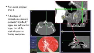 • Navigation-assisted
Draf-I.
• Advantage of
navigation assistance
to identify this bulky
agger nasi cell and the
upper part of the
uncinate process
during navigation.
 