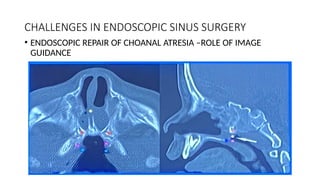 CHALLENGES IN ENDOSCOPIC SINUS SURGERY
• ENDOSCOPIC REPAIR OF CHOANAL ATRESIA –ROLE OF IMAGE
GUIDANCE
 