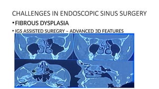 CHALLENGES IN ENDOSCOPIC SINUS SURGERY
•FIBROUS DYSPLASIA
• IGS ASSISTED SUREGRY – ADVANCED 3D FEATURES
 