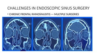 CHALLENGES IN ENDOSCOPIC SINUS SURGERY
• CHRONIC FRONTAL RHINOSINUSITIS --- MULTIPLE SURGERIES
 
