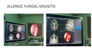 ALLERGIC FUNGAL SINUSITIS
 